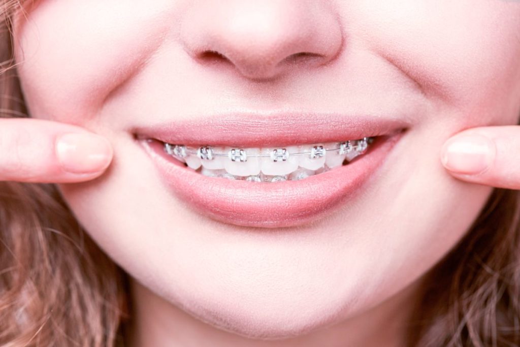 Adult Braces: It's Not Too Late to Get a Confident Smile