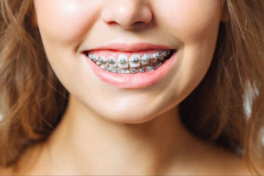 5 Tips for Braces and Invisalign