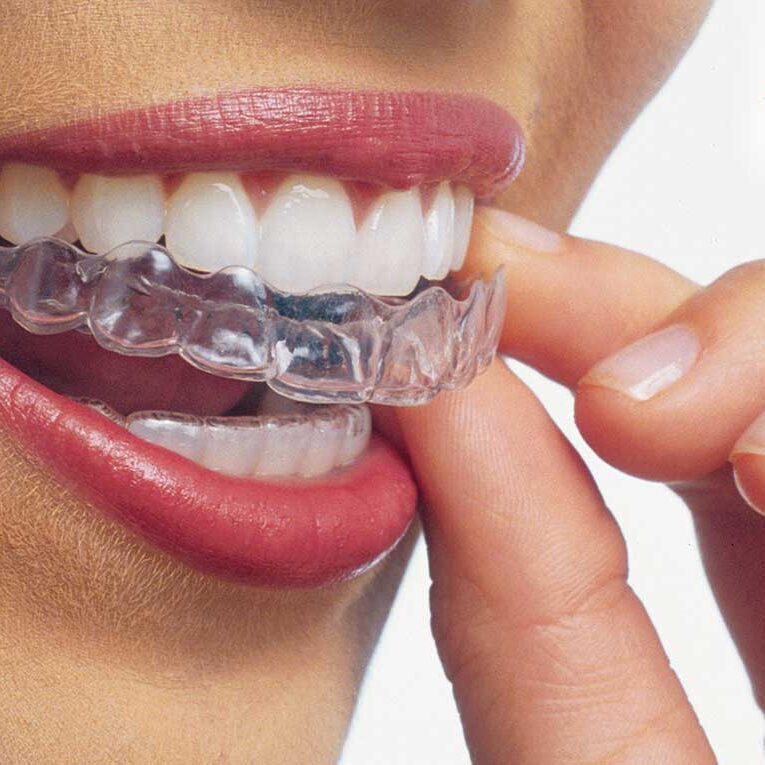 Clifton Invisalign